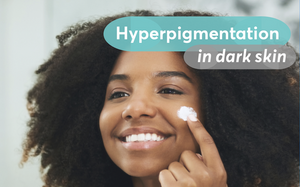 Hyperpigmentation: Let's discuss....